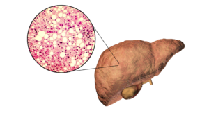 Excess Levels of Ethanol-producing Klebsiella Pneumoniae Strain Emerge as New Potential Culprit for Fatty Liver Disease