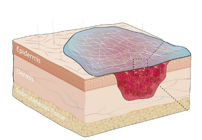 Chinese Team Creates Bacterial Cellulose-based Dressing for Burn Wound Healing
