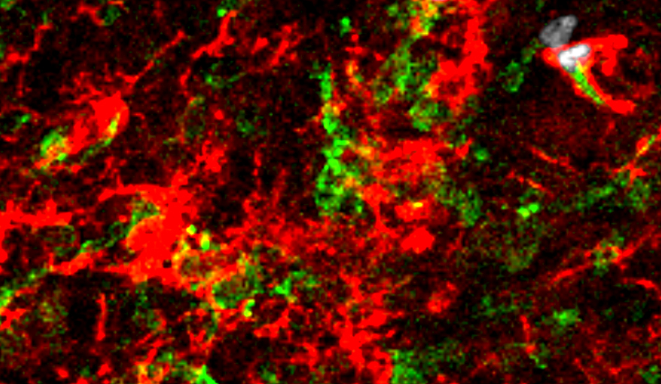 Researchers Identify New Cell Source for Microgliosis in Neurodegenerative Diseases