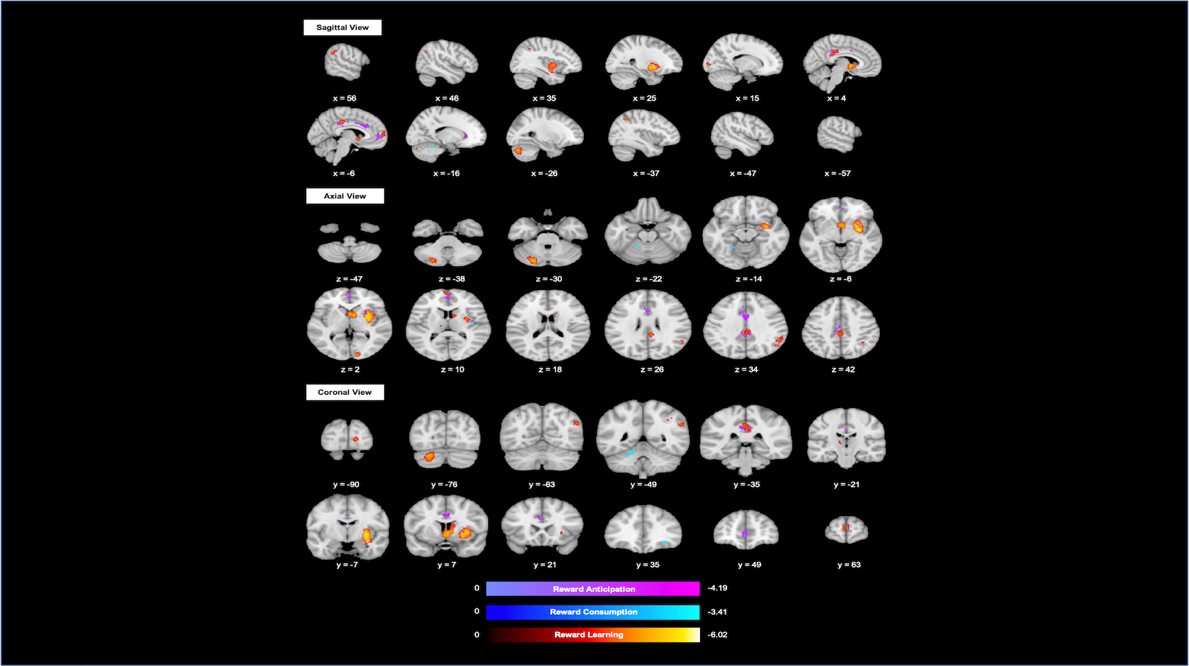 Anhedonia in Schizophrenia Spectrum Involves Alterations in Striatum, Orbital Frontal Cortex, Cingulate Cortex and Cerebellum