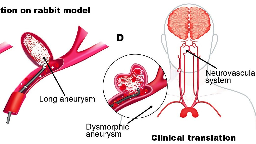 Preshaped 4D Photocurable Ultratough Organogel Microcoils for Personalized Endovascular Embolization