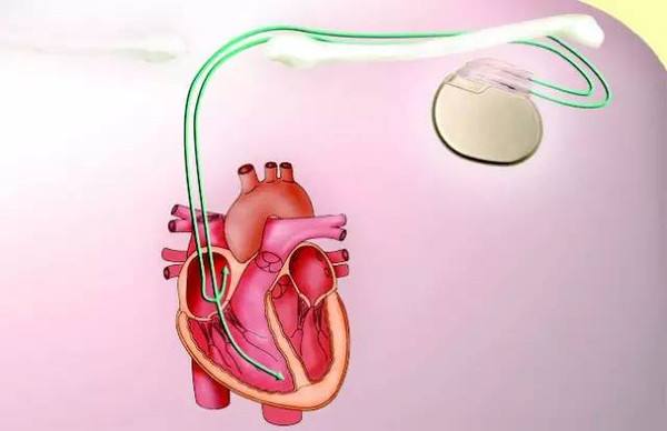 cardiac pacemaker.jpg