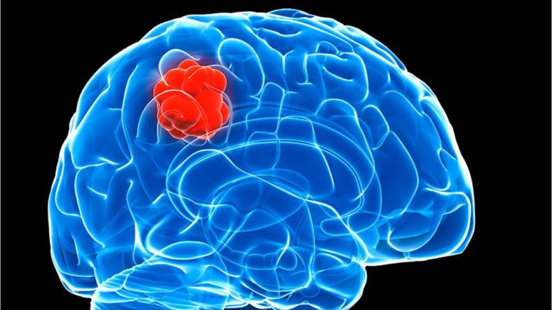 Researchers Discover Potential New Treatment for Glioma