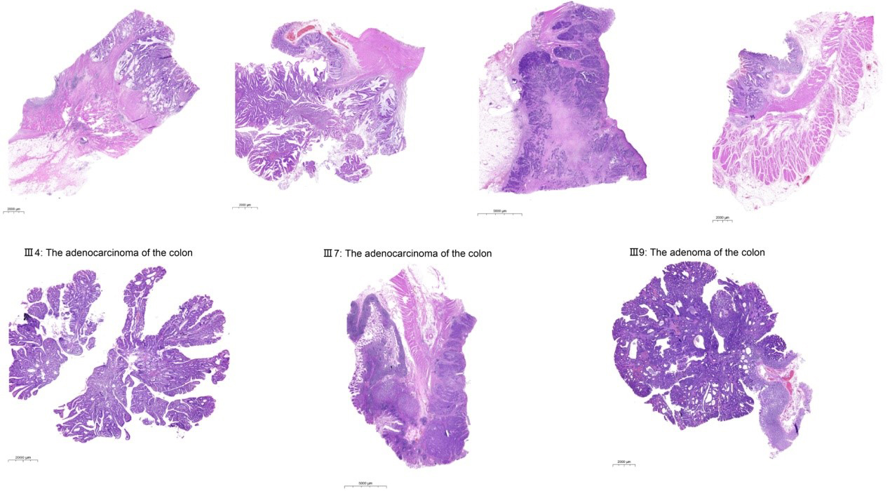 Hematoxylin-eosin staining of colorectal adenocarcinoma or adenomas in all patients.jpg