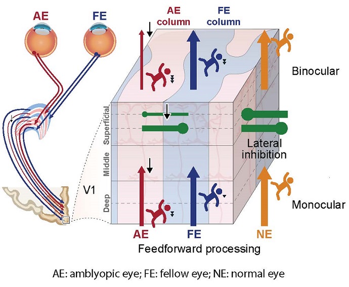 Ultra-High-Resolution Brain Imaging Reveals Key Neural Deficits in Amblyopia