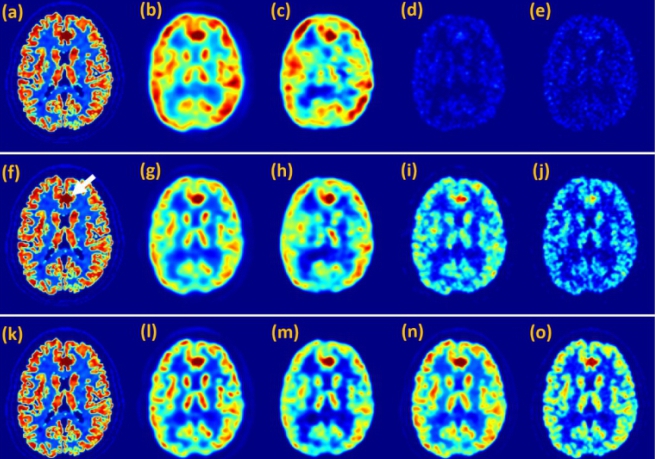 Researchers Propose Novel Deep Learning Method for Positron Emission Tomography Imaging Reconstruction
